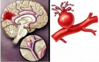 胶原蛋白肽地龙蛋白对脑血栓的作用