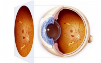 糖尿病视网膜病变早期有什么症状，怎么才能治疗好糖尿病视网膜病变