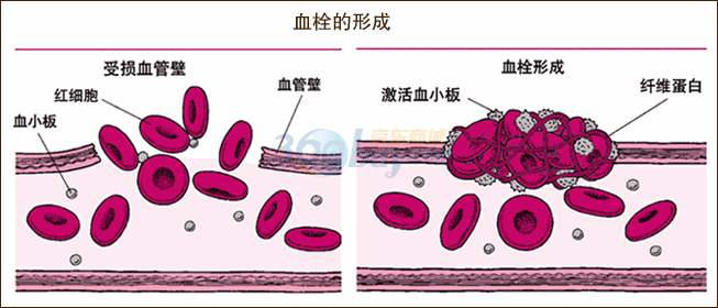 血栓.jpg