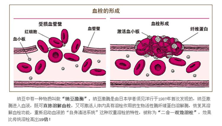 血栓溶解.jpg