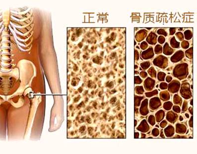 骨质疏松1.jpg