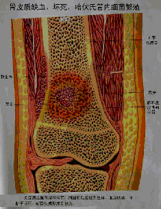 骨髓炎2.jpg