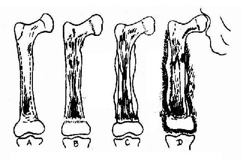 骨髓炎1.jpg