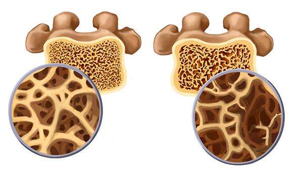 骨质疏松症.jpg