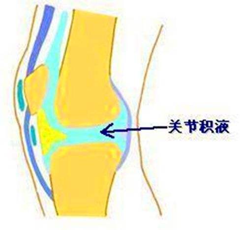膝关节积液滑膜炎.jpg