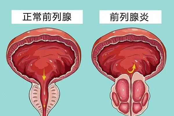 前列腺炎有什么危害?牡蛎肽对改善前列腺功能有什么作用-补骨髓论坛