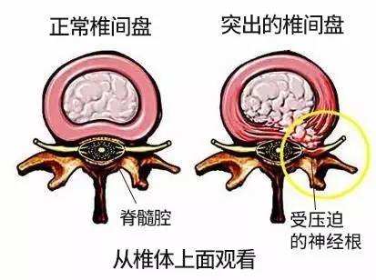 腰间盘突出.jpg