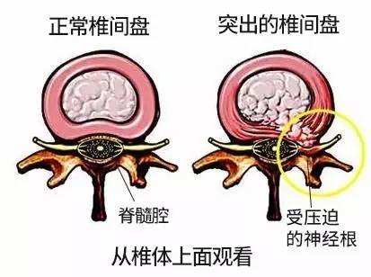 腰间盘突出.jpg