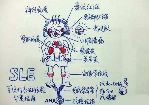 干细胞能治疗系统性红斑狼疮吗.png
