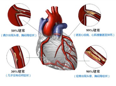 冠心病1.jpg