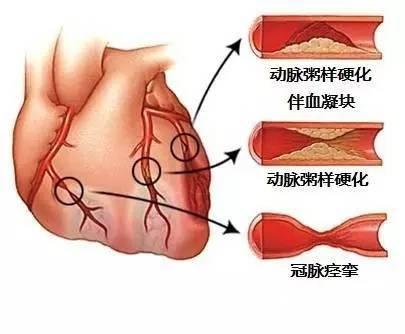 冠状动脉粥样硬化.jpg