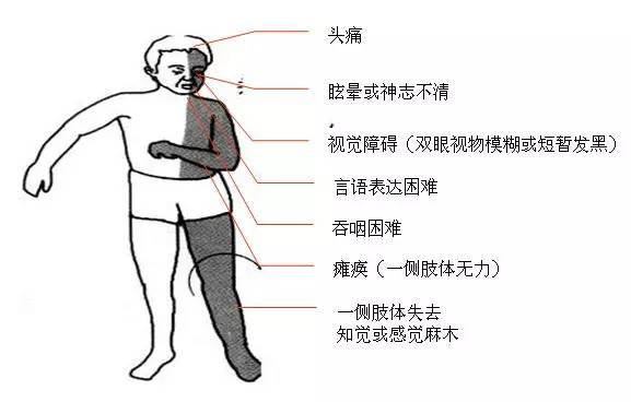 脑中风症状.jpeg