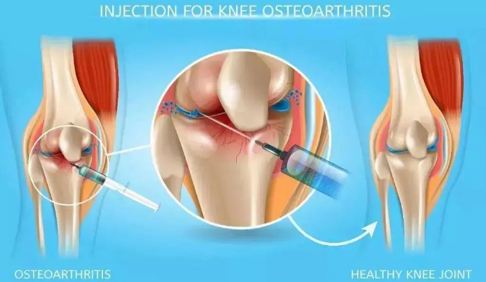 干细胞注射对髌骨损伤效果怎么样.png