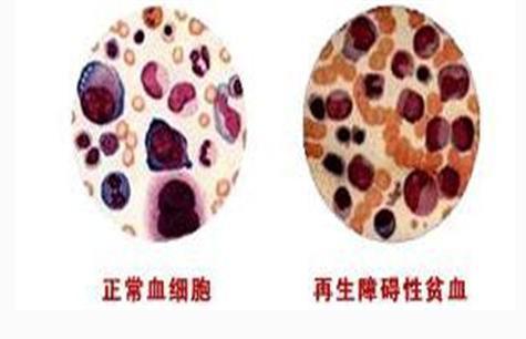 再生障碍性贫血1.jpeg 再生障碍性贫血1.jpeg