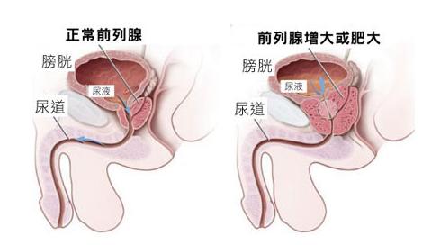 前列腺炎.jpg