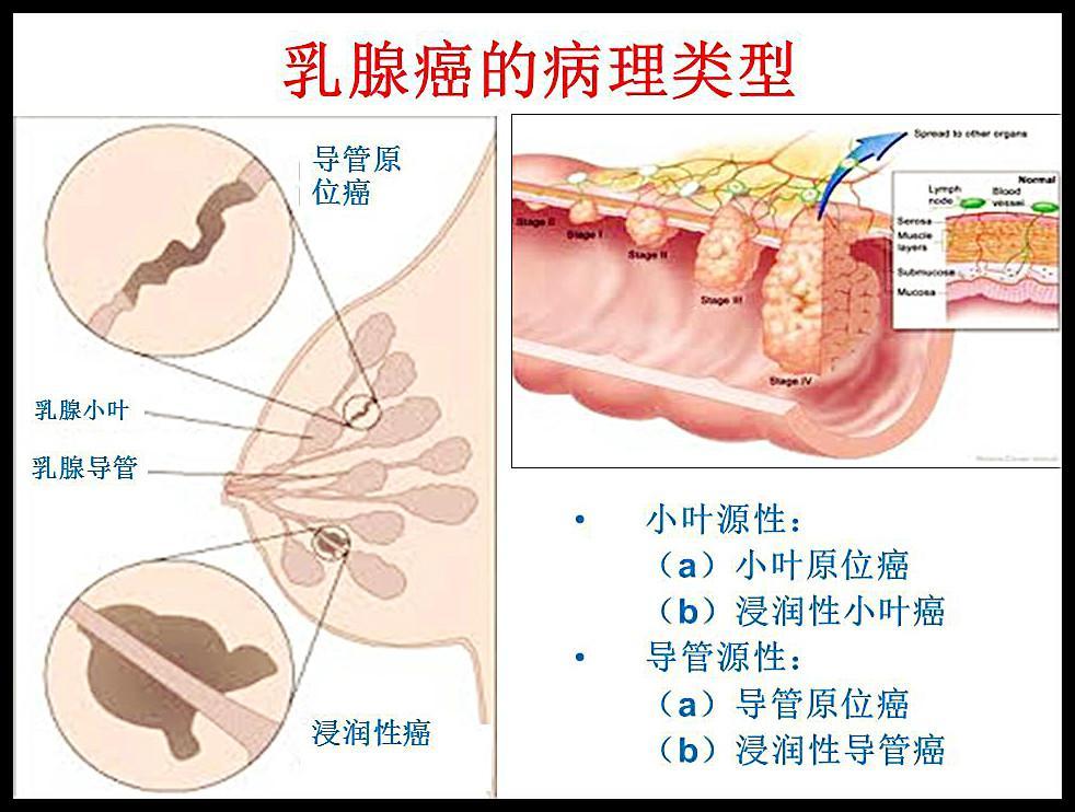 乳腺癌.jpeg