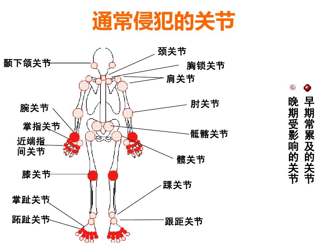 风湿病关节炎.jpg