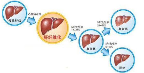 肝纤维化.jpg