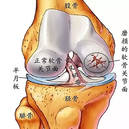 膝关节炎1.jpg