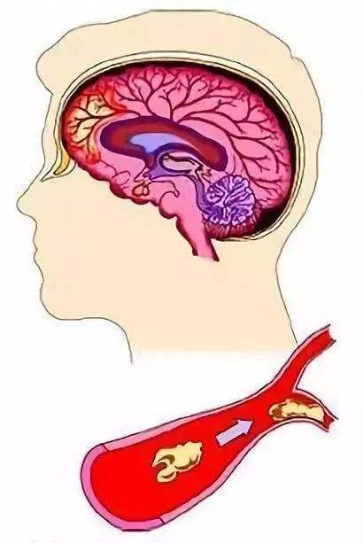 脑卒中.jpg 脑卒中.jpg