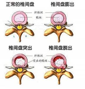 腰椎间盘突1.jpg