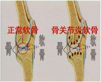 骨关节炎1.jpg