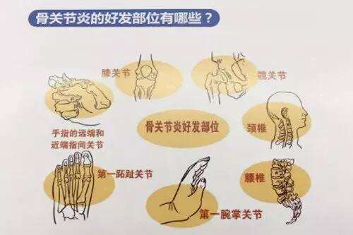 骨关节炎.jpg