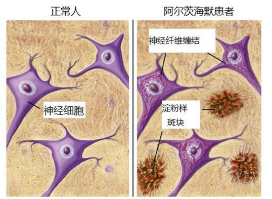 干细胞注射能治疗老年痴呆吗.png