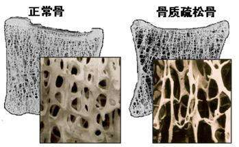 骨质疏松2.jpg