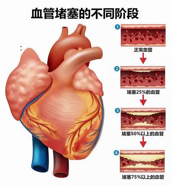 血管堵塞2.jpg