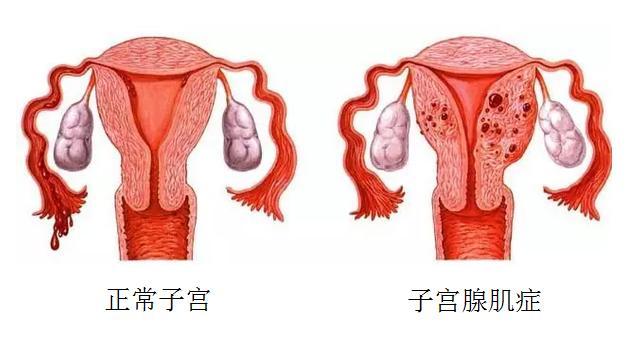 子宫腺肌症.jpg