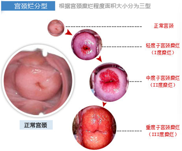 宫颈糜烂.jpeg