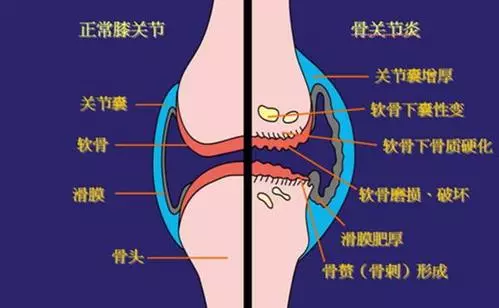 增生性骨关节病.jpg