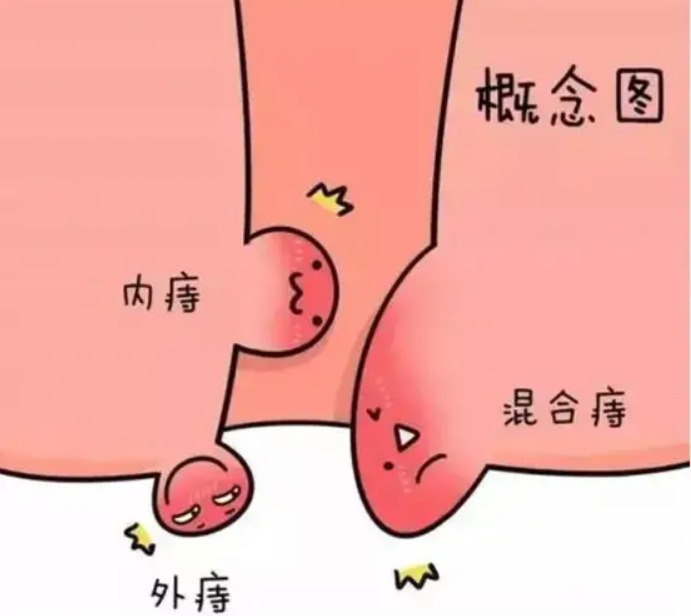 痔疮怎么治疗.png