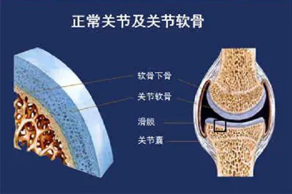 关节炎怎么才能治疗好，吃胶原蛋白肽对关节炎作用怎么样