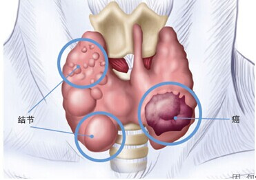 结节的发病原因.jpg