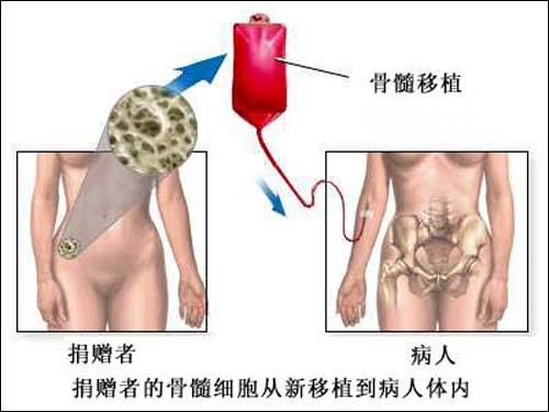 骨髓移植.jpg
