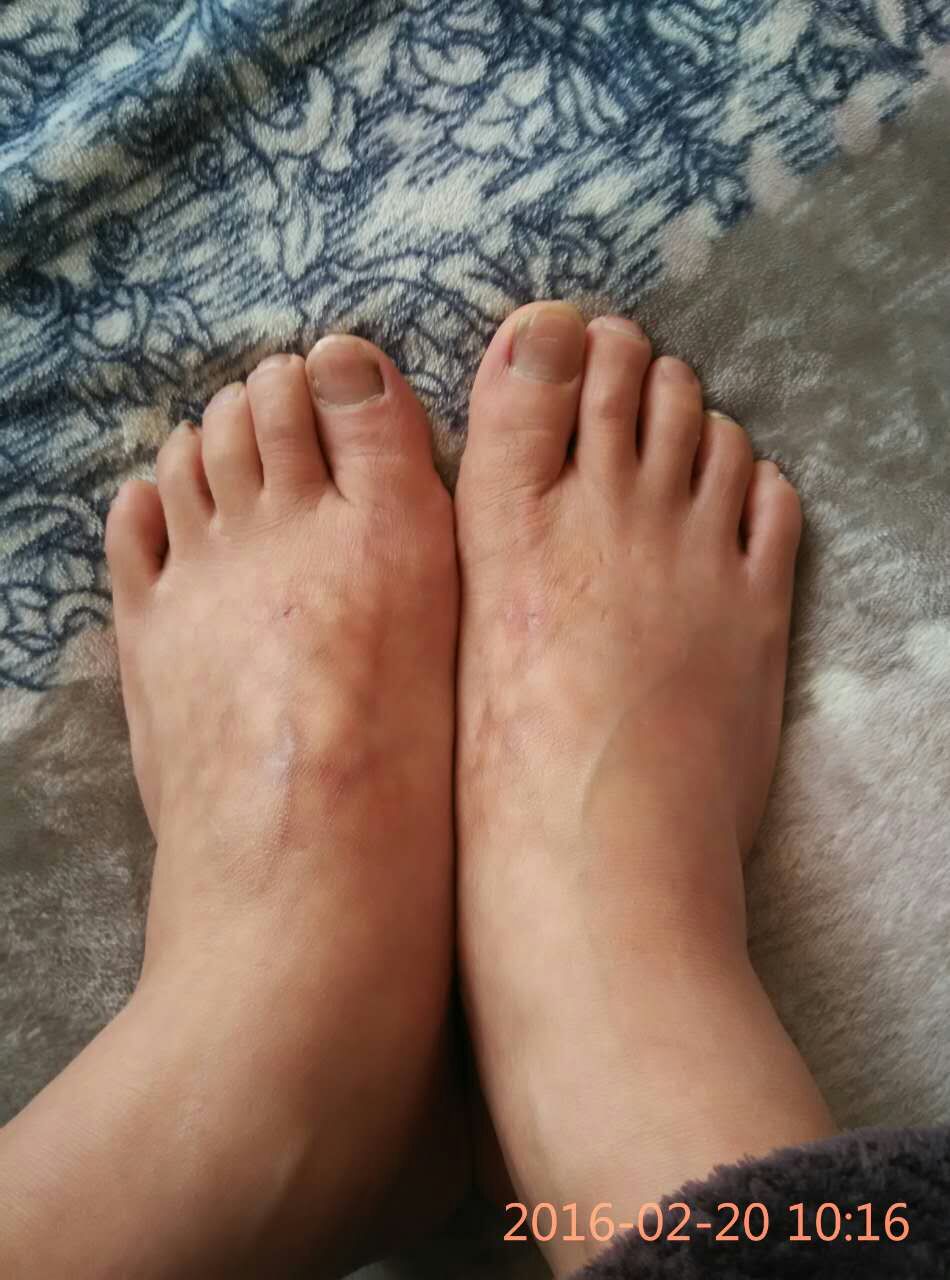 腰椎间盘突出.jpg