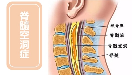 脊髓空洞.jpg