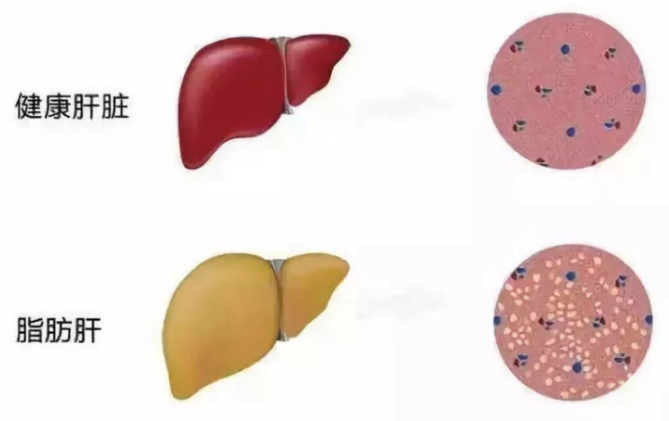 干细胞对重度脂肪肝效果怎么样，脐带血干细胞疗法对肝脏的效果怎么样