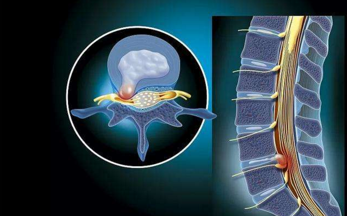 干细胞疗法对修复腰椎间盘效果好吗，脐带血干细胞与椎间盘