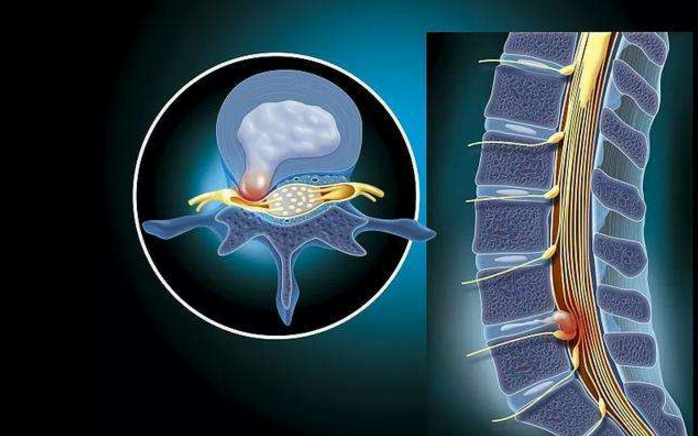 干细胞注射疗法对腰椎间突出好吗？能不能根治