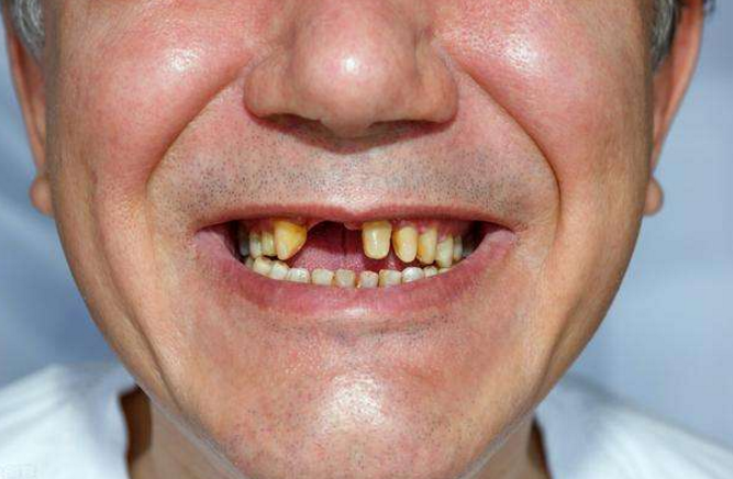 牙龈萎缩是什么原因？怎么治疗？