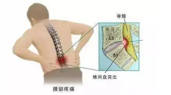 药灸能治疗腰椎间盘突出吗.png