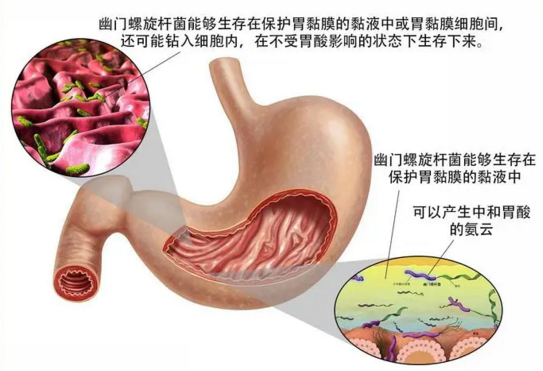 幽门螺杆菌用四联疗法能根除吗