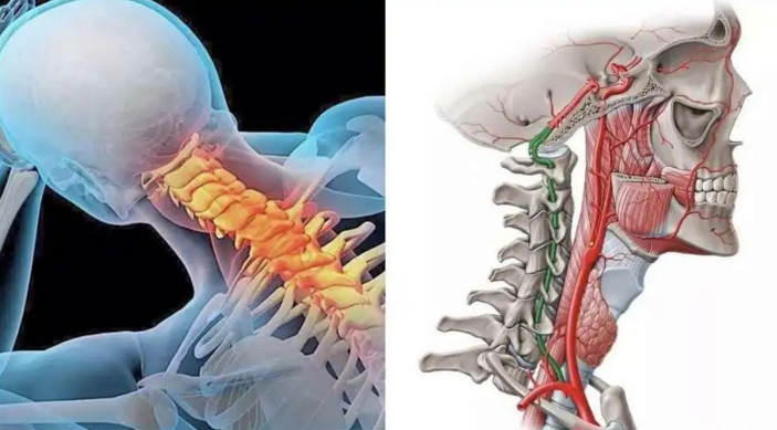 富贵包的形成与颈椎的结构有关