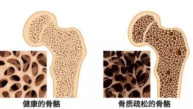 胶原蛋白肽促进骨关节的再生和预防质疏松