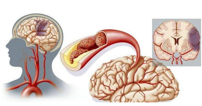 活性肽对脑血栓预防与改善