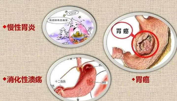 感染幽门螺旋杆菌怎么治疗效果好？