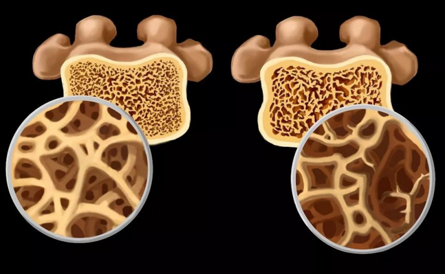 类风湿也会导致骨质增生！